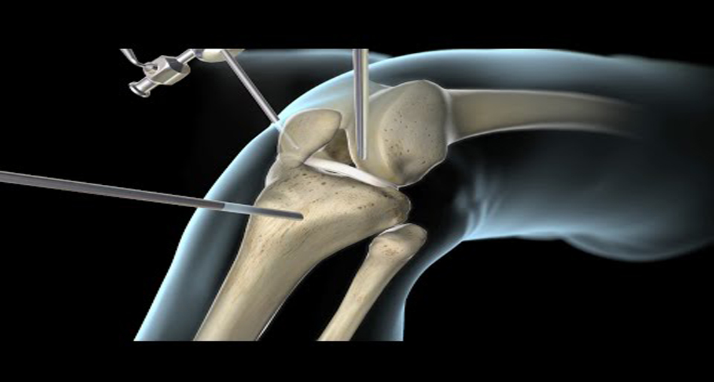 ACL injury & when should you consult a sports surgeon.